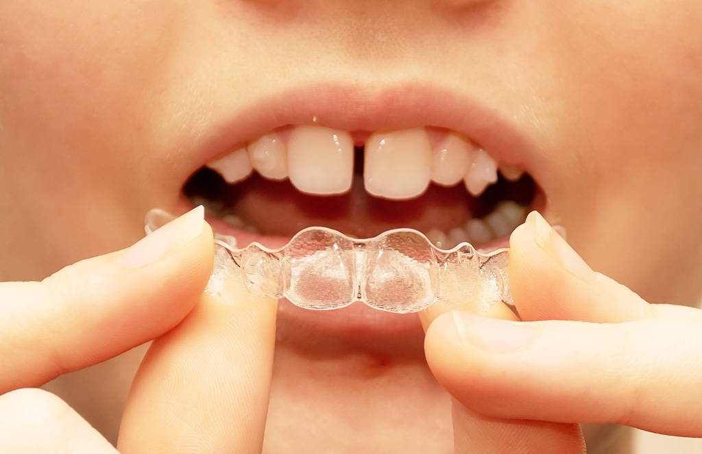 中区丸の内・医療法人みずの歯科医院
・シュアスマイル